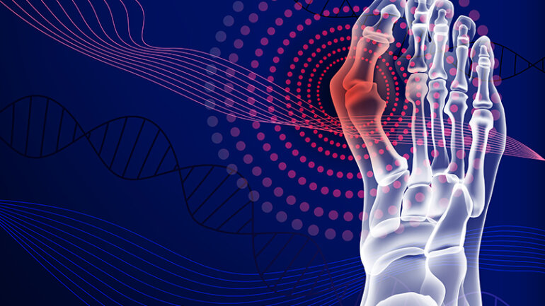 Βλαισός μέγας δάκτυλος (κότσι): Διόρθωση με διαδερμική τεχνική τρίτης γενιάς στο Metropolitan Hospital