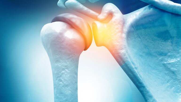 Αρθροσκόπηση: Η πιο σύγχρονη μέθοδος αντιμετώπισης ρήξης τενόντων του ώμου