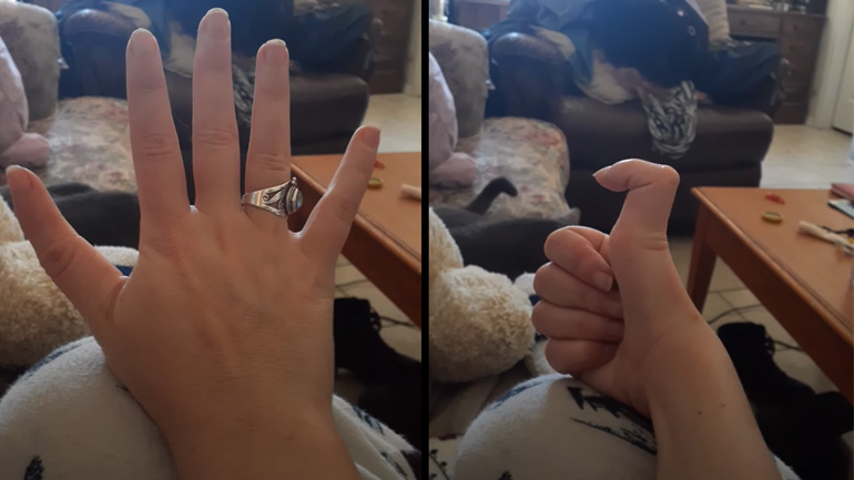 Αντίχειρας με τρεις αρθρώσεις 