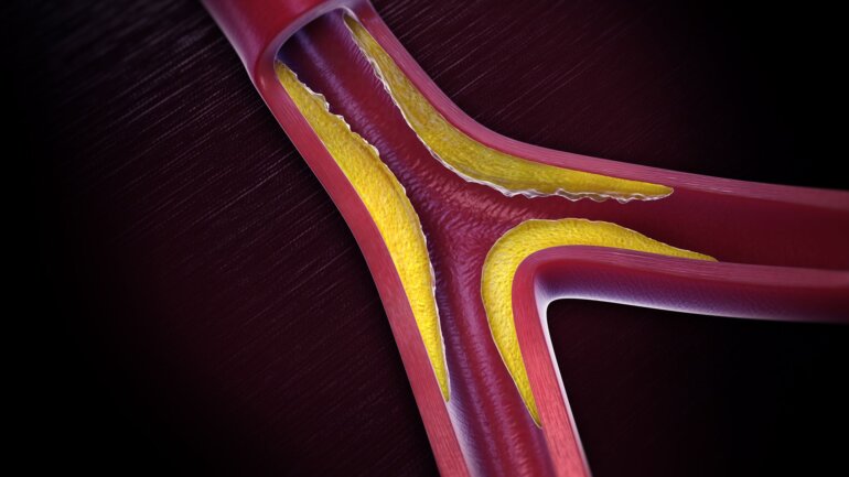Πρωτεΐνη ανακαλύφθηκε ότι παίζει σημαντικό ρόλο στην αθηροσκλήρωση