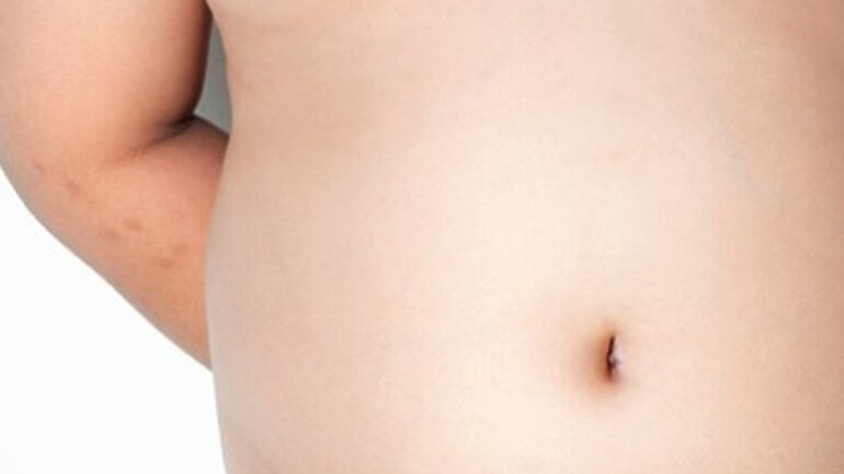 Η φλεγμονή είναι αυξημένη στα παιδιά με παραπανίσιο σωματικό λίπος