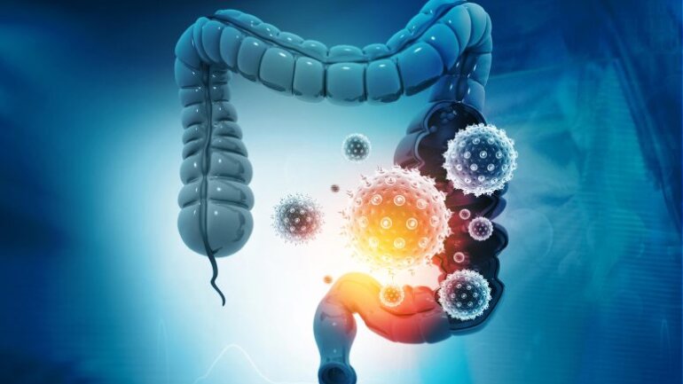 Τα μωρά που γεννήθηκαν με καισαρική έχουν αρχικά ελλειμματικό μικροβίωμα