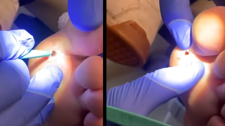 Γιατρός αφαιρεί θραύσμα από μια πατούσα