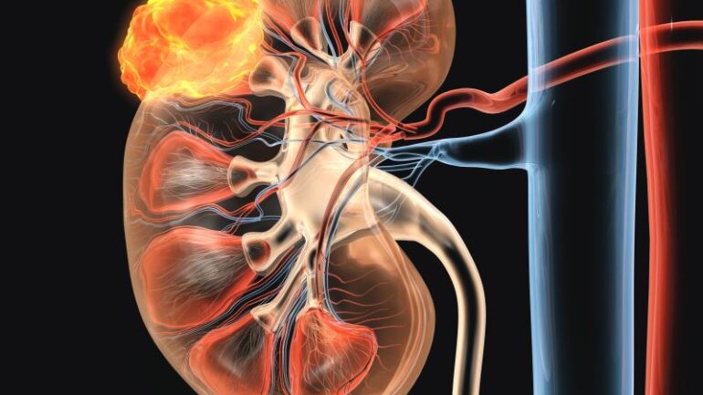 Έγκριση από την ΕΕ ο συνδυασμός nivolumab με cabozantinib ως θεραπεία για προχωρημένο νεφροκυτταρικό καρκίνωμα