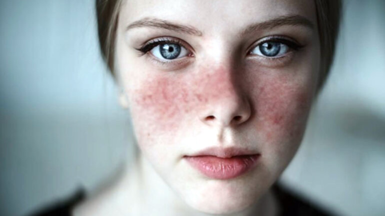 Οι ασθενείς με Λύκο βιώνουν μείωση της πρόσβασης στην υγειονομική περίθαλψη στη πανδημία