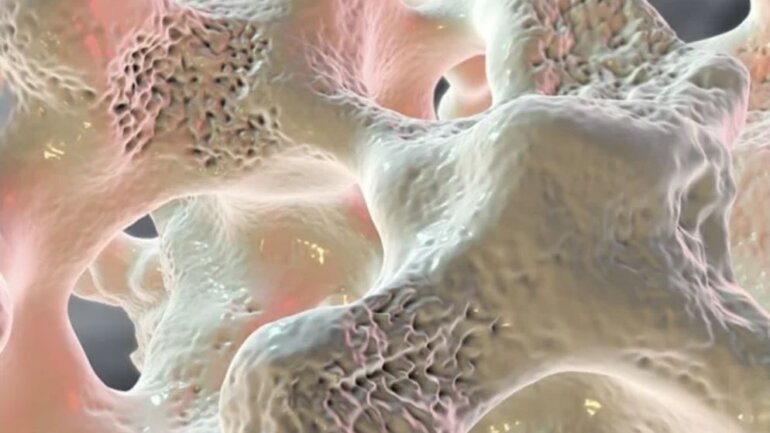 Οστεοπόρωση: Πέντε πολύτιμες τροφές και βιταμίνες για να τη νικήσεις