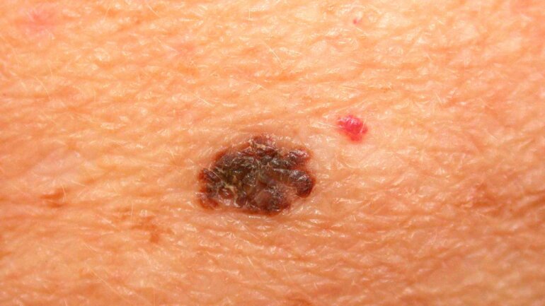 Εβδομάδα δωρεάν δερματολογικού ελέγχου στο Metropolitan Hospital