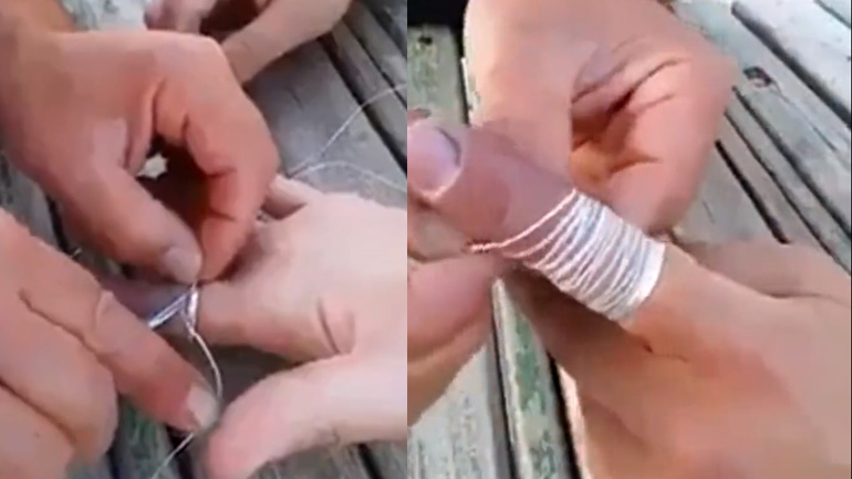 Πώς να βγάλετε το δαχτυλίδι που «κόλλησε» στο δάχτυλό σας 