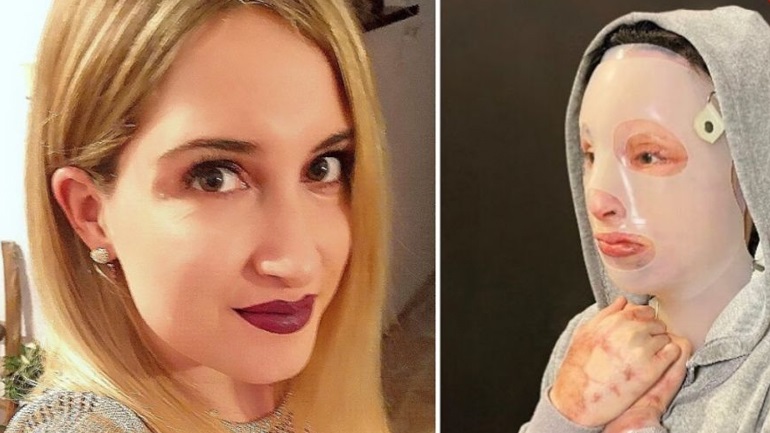 Επίθεση με βιτριόλι: Η Ιωάννα δείχνει τα εγκαύματα στο χέρι της