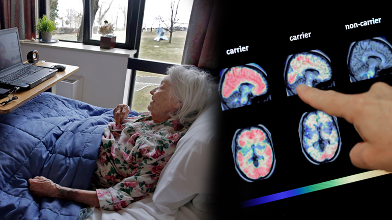 Στην κυκλοφορία νέο φάρμακο για το Αλτσχάιμερ