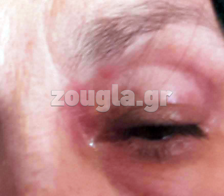 Φωτογραφία με τα συμπτώματα