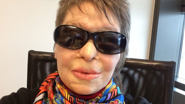 Παρέμβαση Κούνεβα μετά την επίθεση με βιτριόλι στη Μονή Πετράκη