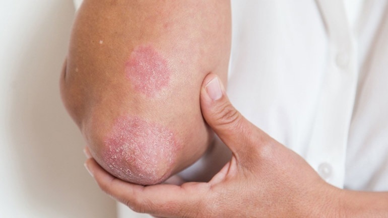 Ψωρίαση και αντιφλεγμονώδης διατροφή