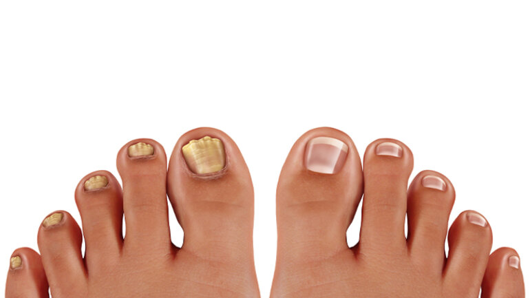 Ονυχομυκητίαση: Ένα μικρό πρόβλημα με μεγάλο χρόνο θεραπείας