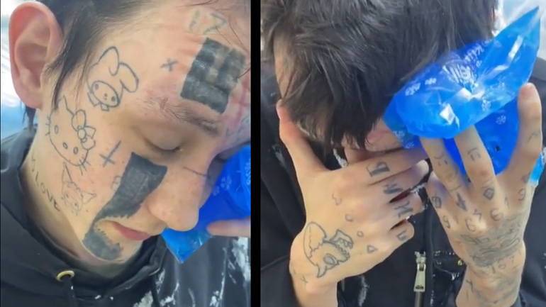 Αφαίρεση τατουάζ με λέιζερ