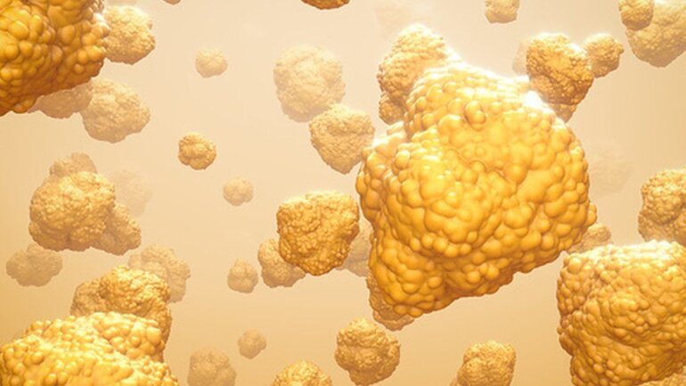 Τα πολλά λιπαρά αυξάνουν την πιθανότητα εμφάνισης καρκίνου του παχέος εντέρου