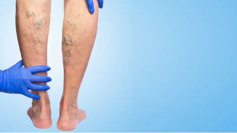 Τέλος στο πρόβλημα των κιρσών με τεχνολογία laser