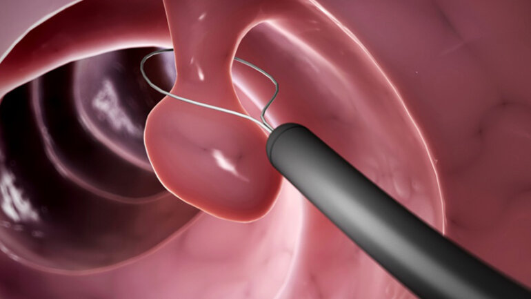 Κολονοσκόπηση, για την πρόληψη του καρκίνου του παχέος εντέρου