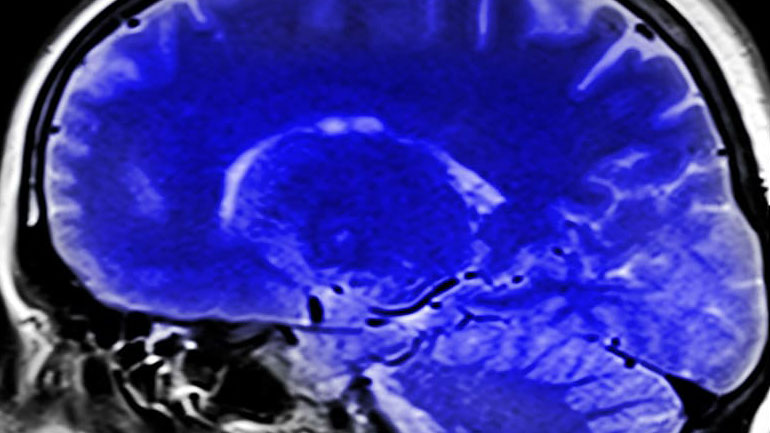 Νέα «υπερηχητική» μέθοδος θεραπείας κατά του καρκίνου του εγκεφάλου