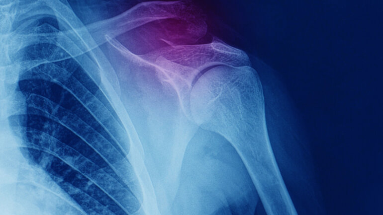 Οστεοπορωτικά κατάγματα: Η «μάστιγα» του 21ου αιώνα