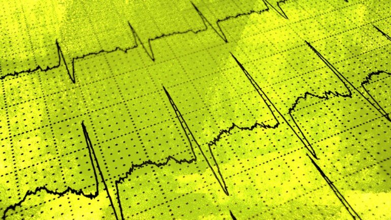 Το αλκοόλ -και όχι άλλοι παράγοντες- μπορεί να πυροδοτήσει καρδιακή αρρυθμία