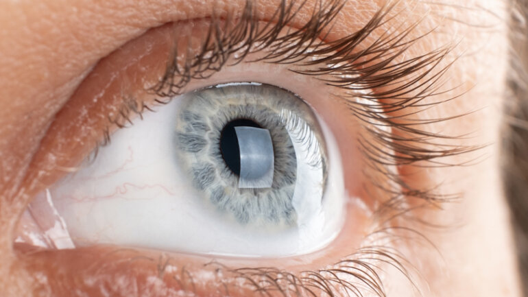 Κερατόκωνος: Επιπτώσεις και τρόποι αντιμετώπισης