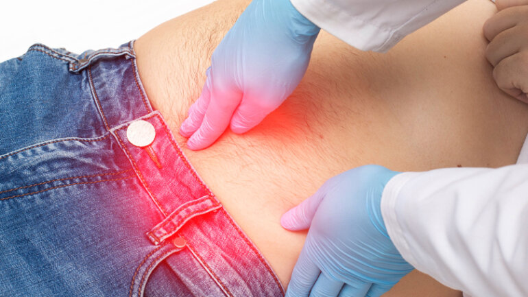 Περίσφιξη κήλης: Γιατί δεν πρέπει να αναβάλλεται το χειρουργείο