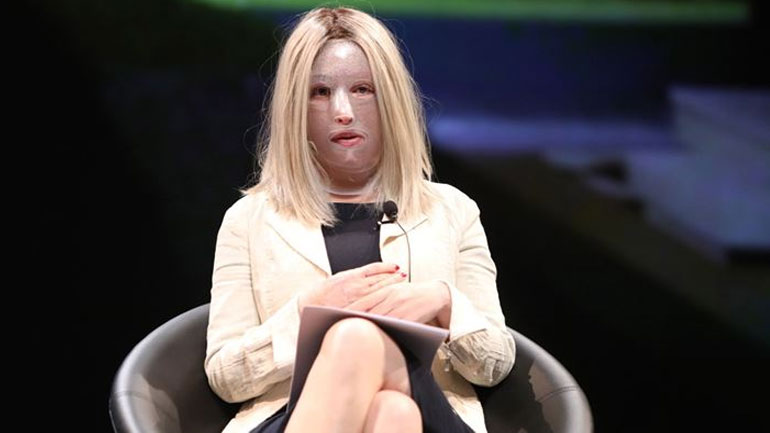 Ιωάννα Παλιοσπύρου: Η γυμνάστριά της μιλάει για τη γυμναστική που ακολουθεί μετά την επίθεση με βιτριόλι