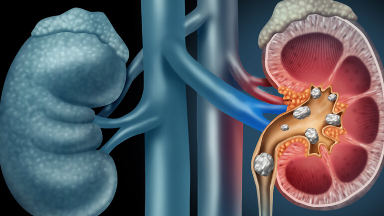 Πέτρες στα νεφρά και σύγχρονη αντιμετώπιση
