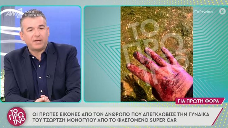 Τζώρτζης Μονογυιός: Στη δημοσιότητα οι φωτογραφίες με τα εγκαύματα του ανθρώπου που απεγκλώβισε το ζευγάρι