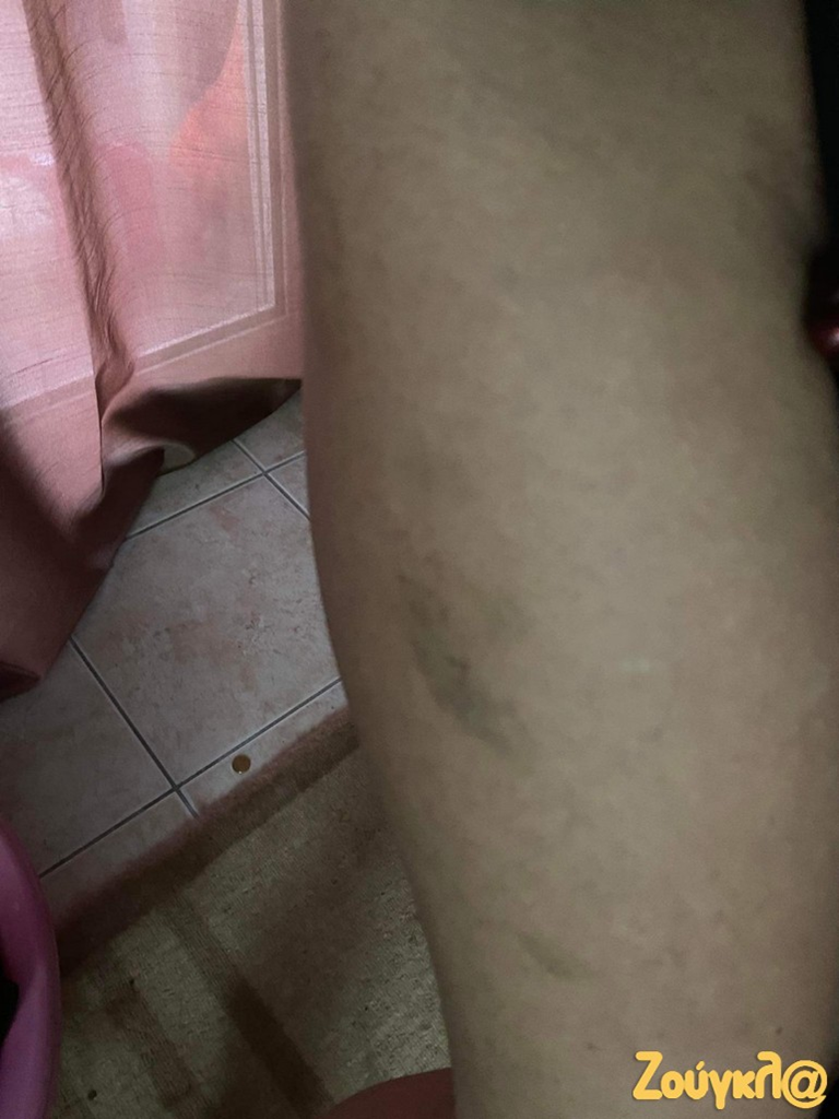 Η Γεωργία φωτογράφισε η ίδια τους μώλωπες που έχει στο σώμα της από το βράδυ της Πρωτοχρονιάς