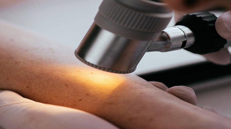 Οι μεταστάσεις εμφανίζονται στο 2% των δερματικών καρκινωμάτων πλακωδών κυττάρων