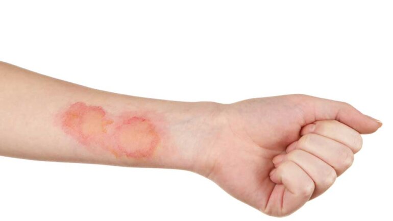 Τα εγκαύματα σχετίζονται με καρδιακές προσβολές αργότερα