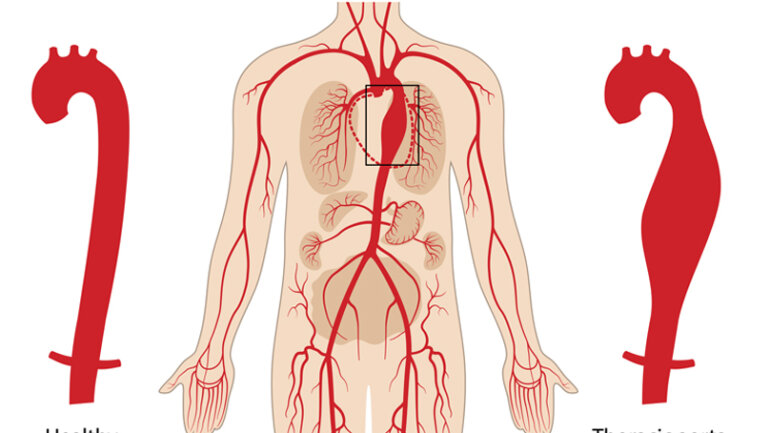 Διακαθετηριακή αντιμετώπιση ανευρυσμάτων