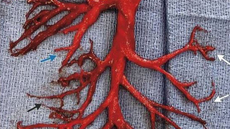 ΘΡΟΜΒΟΙ ΑΠΟ «ΕΜΒΟΛΙΑ»-COVID – ΤΙ ΣΥΜΒΑΙΝΕΙ; όταν το αίμα μετατρέπεται σε ζελατινώδη μάζα ΘΡΟΜΒΟΙ ΑΠΟ «ΕΜΒΟΛΙΑ»-COVID – ΤΙ ΣΥΜΒΑΙΝΕΙ; όταν το αίμα μετατρέπεται σε ζελατινώδη μάζα