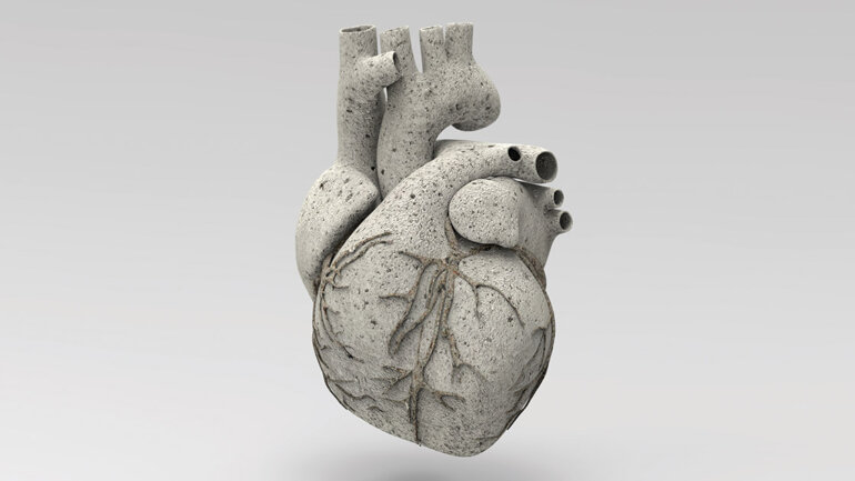 Η υψηλή βαθμολογία ασβεστίου των καρδιακών αρτηριών αυξάνει τον κίνδυνο καρδιακής προσβολής