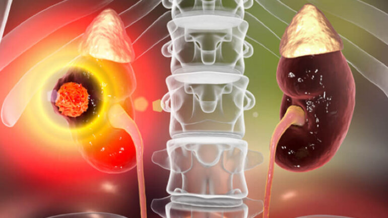 Καρκίνος του νεφρού: Ένας σιωπηλός εχθρός