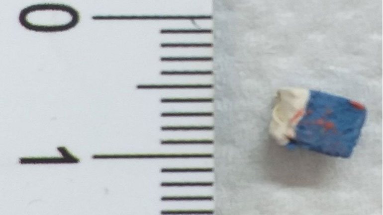 Θεσσαλονίκη: Σώθηκε μωρό 16 μηνών που είχε καταπιεί γομολάστιχα