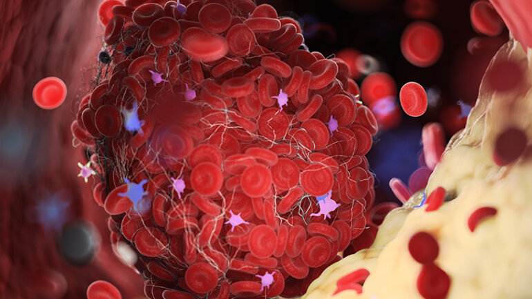 Διάγνωση των λιπιδίων που μπορεί να σώσει τη ζωή μας