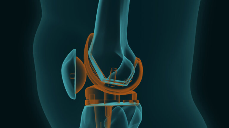 Τι ισχύει για την αρθροπλαστική γόνατος και ισχίου