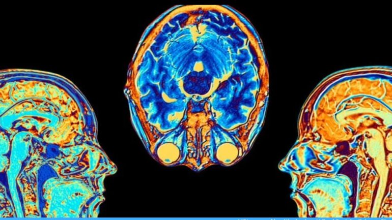 Ακόμη και μια ήπια νόσος COVID συνδέεται με αλλαγές στον εγκέφαλο