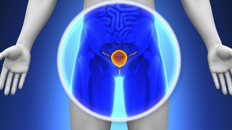 Εξαρτάται η αποκατάσταση της σεξουαλικής λειτουργίας μετά από ριζική προστατεκτομή από τον χειρουργό;