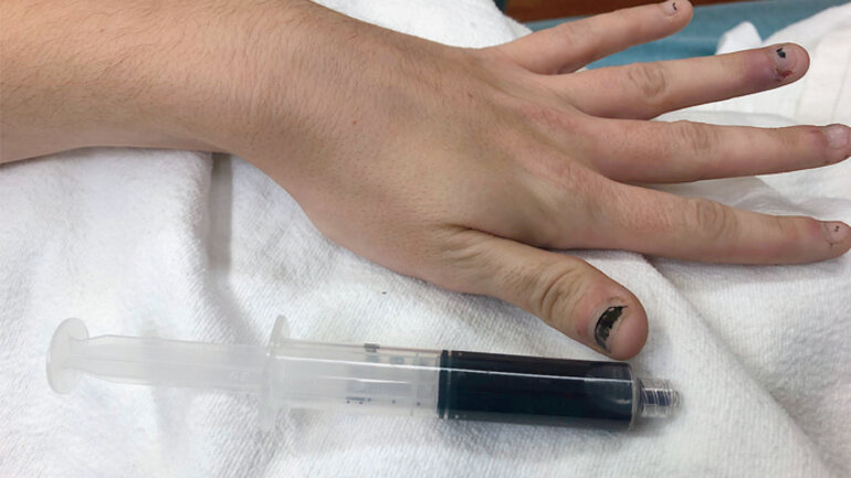 Γιατί πραγματικά δεν θα θέλατε να έχετε μπλε αίμα