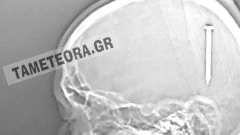 Καλαμπάκα: Καρφί πέντε εκατοστών σφηνώθηκε στο κεφάλι άνδρα και επέζησε Καλαμπάκα: Καρφί πέντε εκατοστών σφηνώθηκε στο κεφάλι άνδρα και επέζησε