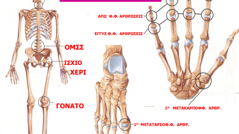 Ρευματοειδής Αρθρίτιδα: Απλά μια ασθένεια των αρθρώσεων;