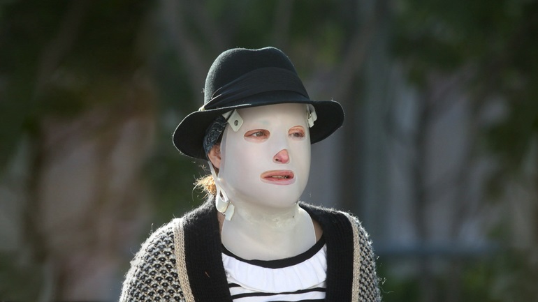 Η Ιωάννα Παλιοσπύρου δείχνει το πρόσωπό της για πρώτη φορά μετά την επίθεση με βιτριόλι