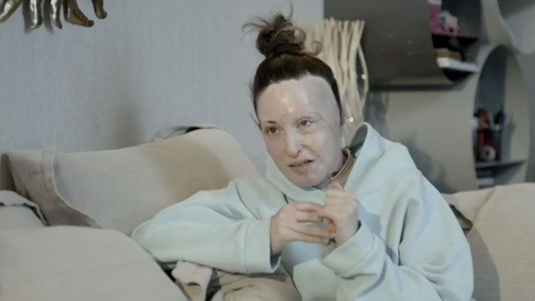 Ιωάννα Παλιοσπύρου: Έδειξε το πρόσωπό της και περιέγραψε την επίθεση με το βιτριόλι