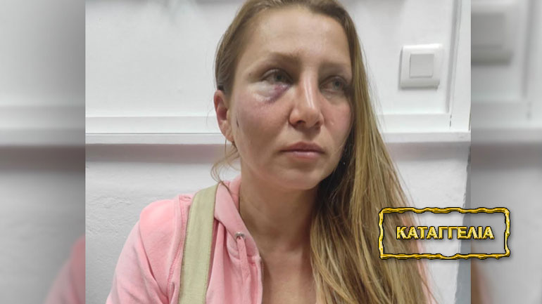 Άγιος Κοσμάς: Ρωσίδα καταγγέλλει επίθεση με σιδηρογροθιά από Ουκρανούς