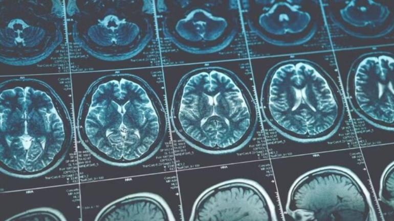 H σοβαρή COVID-19 μπορεί να ισοδυναμεί με γνωστική γήρανση 20 ετών