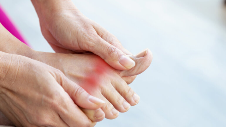 Ουρική αρθρίτιδα: Συμπτώματα, διάγνωση και θεραπεία